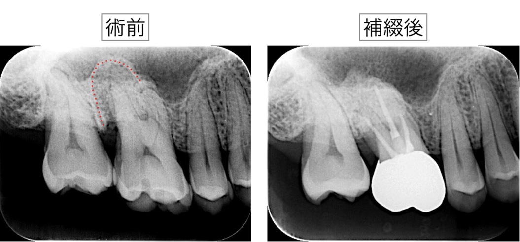根管治療　歯性上顎洞炎　補綴後X線レントゲン画像