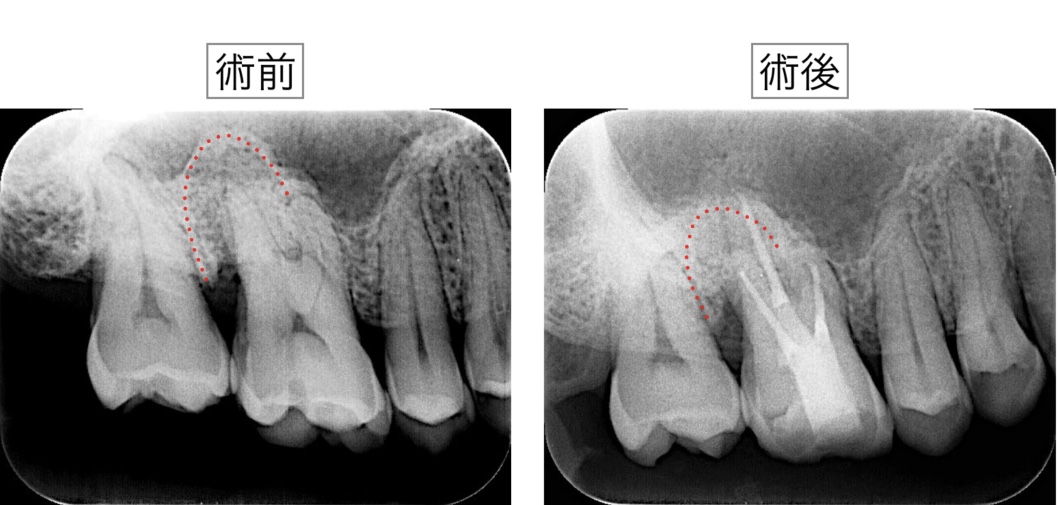 根管治療　歯性上顎洞炎　術前術後X線レントゲン画像