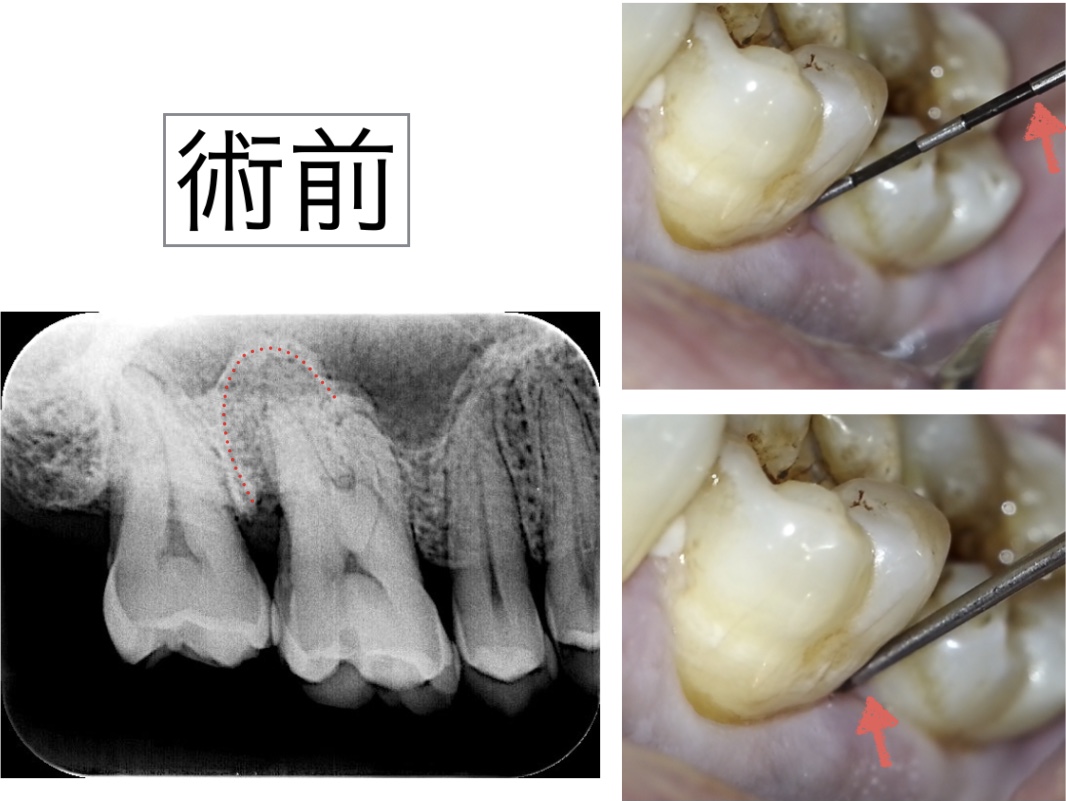 根管治療　歯性上顎洞炎　術前X線レントゲン画像