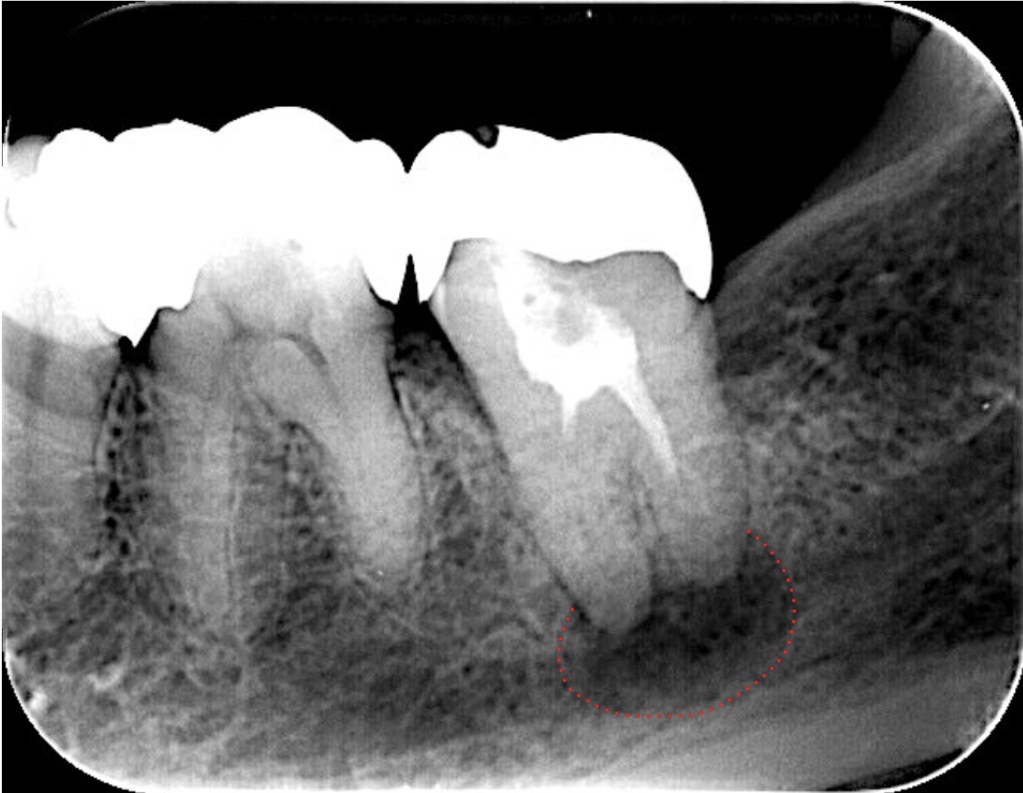 再根管治療　術前X線画像　下歯槽管