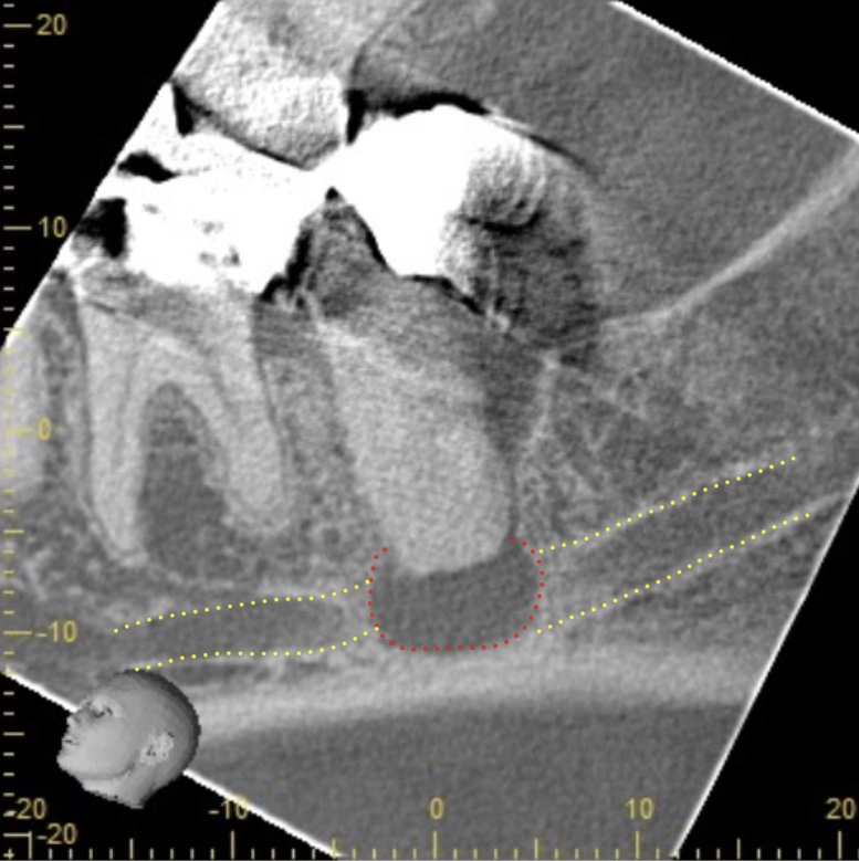 再根管治療　術前CT画像　下歯槽管