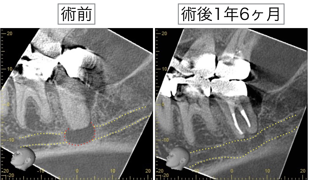 再根管治療　術前術後CT画像　下歯槽管