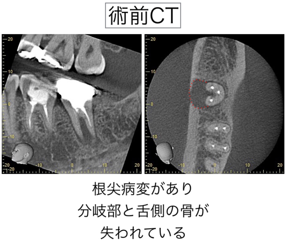 意図的再植術 術前CT画像