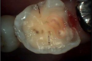 マイクロスコープ　歯髄