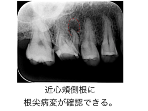 歯根端切除術　術前エックス線画像