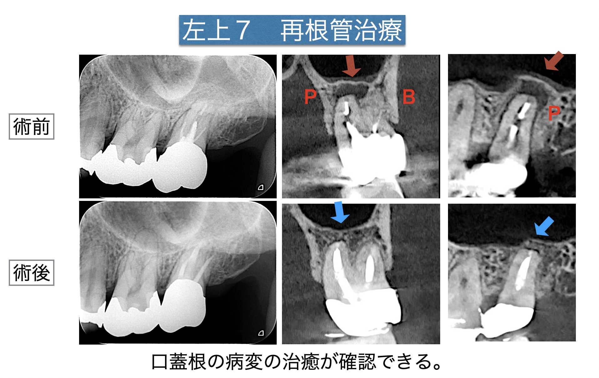 噛むと痛い。抜歯した方が良いと言われたが、歯を残したい。再根管治療