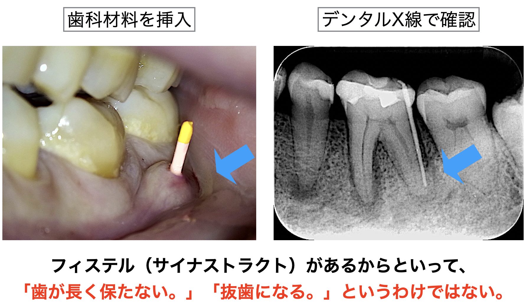 フィステル と は