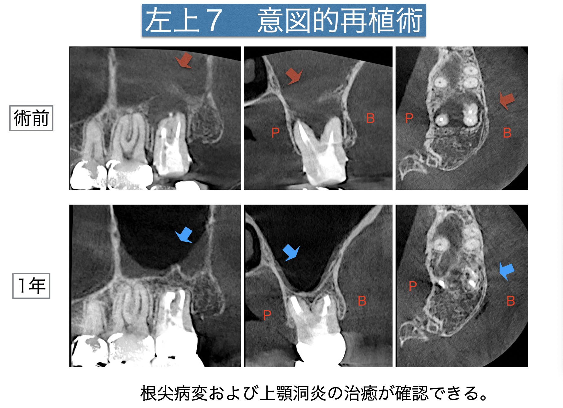 噛むとズーンとして、歯が浮いているような感じがする。歯性上顎洞炎を