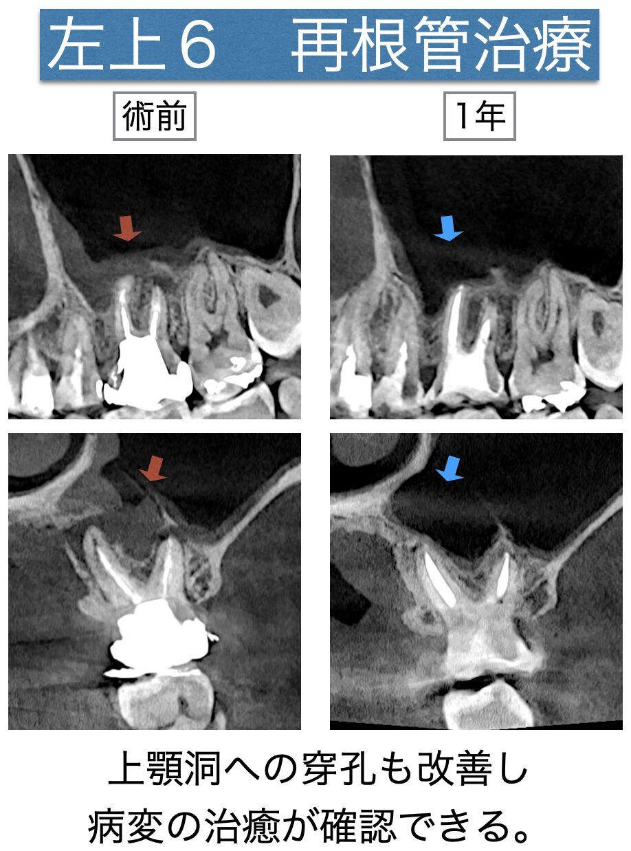 左上の奥歯が歯性上顎洞炎と言われた。再根管治療にて治癒した症例