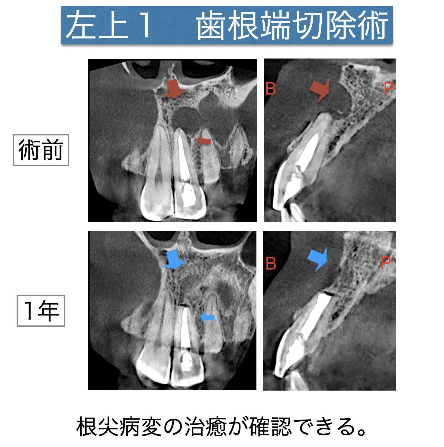 左上前歯の根の先に膿があると言われた。歯根端切除術にて対応した症例